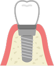 インプラント