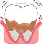歯周病の治療